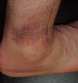 My sprained ankle.